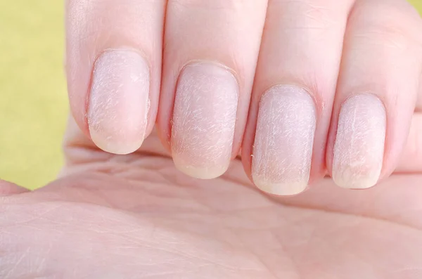 How to Repair Damaged Nails After Acrylics or Gels?